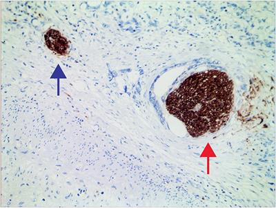 Perineural Invasion and Postoperative Adjuvant Chemotherapy Efficacy in Patients With Gastric Cancer